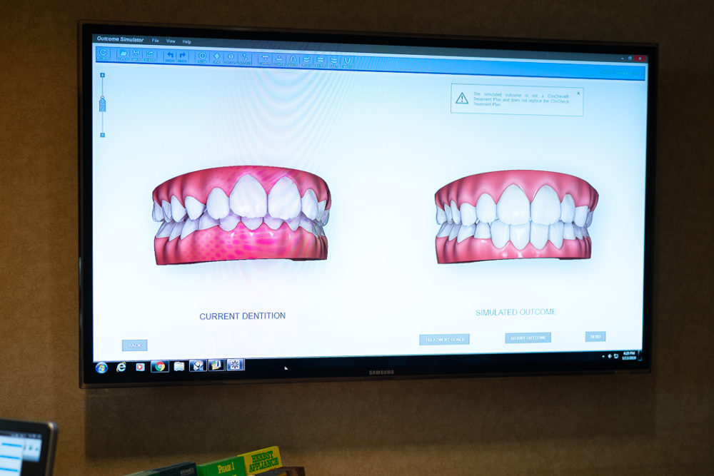 Petite Fashion Blog | Invisalign Review
