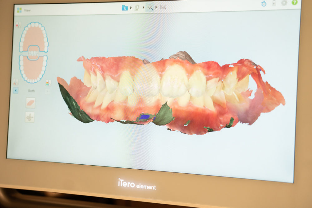 Petite Fashion Blog | Invisalign Review