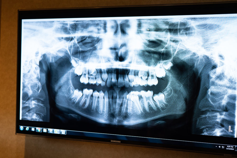 Petite Fashion Blog | Invisalign Review