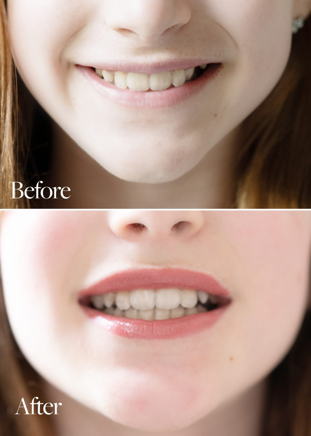 Invisalign before and after